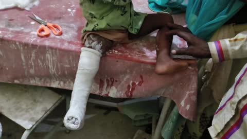 अतरपरी गांव में दुर्घटना में घायल हुआ मासूम